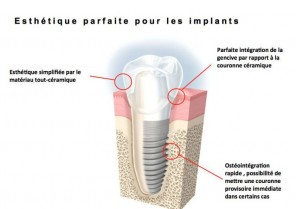 Chirurgie prÃ©-implantaire - Implant dentaire Aix en 
